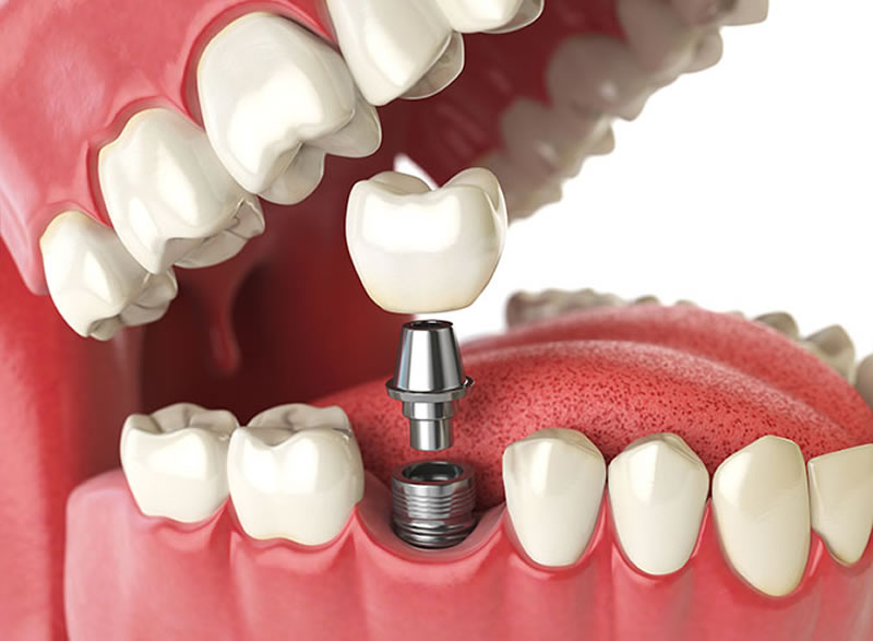 Sorrir e comer com confiança total usando pontes suportadas por implantes